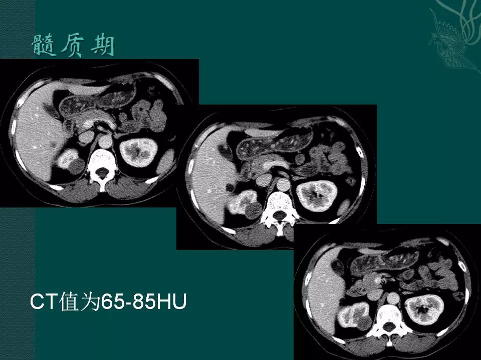 【病例】后肾腺瘤1例CT影像表现 【病例】后肾腺瘤1例CT影像表现
