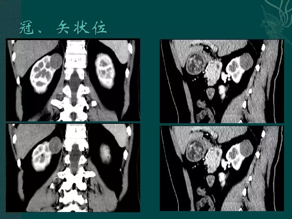 【病例】后肾腺瘤1例CT影像表现 【病例】后肾腺瘤1例CT影像表现