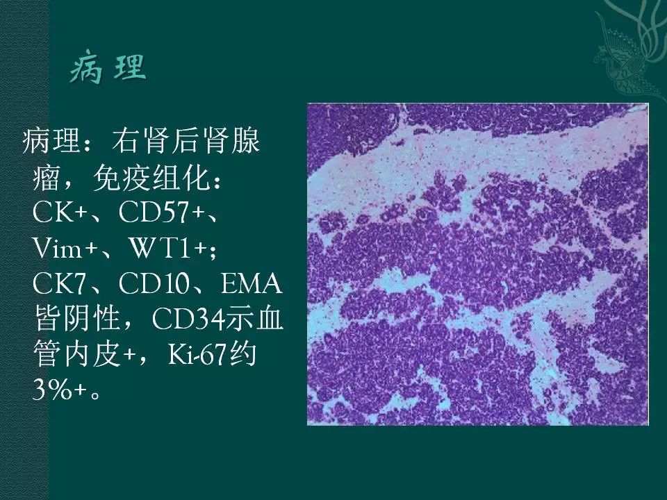 【病例】后肾腺瘤1例CT影像表现 【病例】后肾腺瘤1例CT影像表现