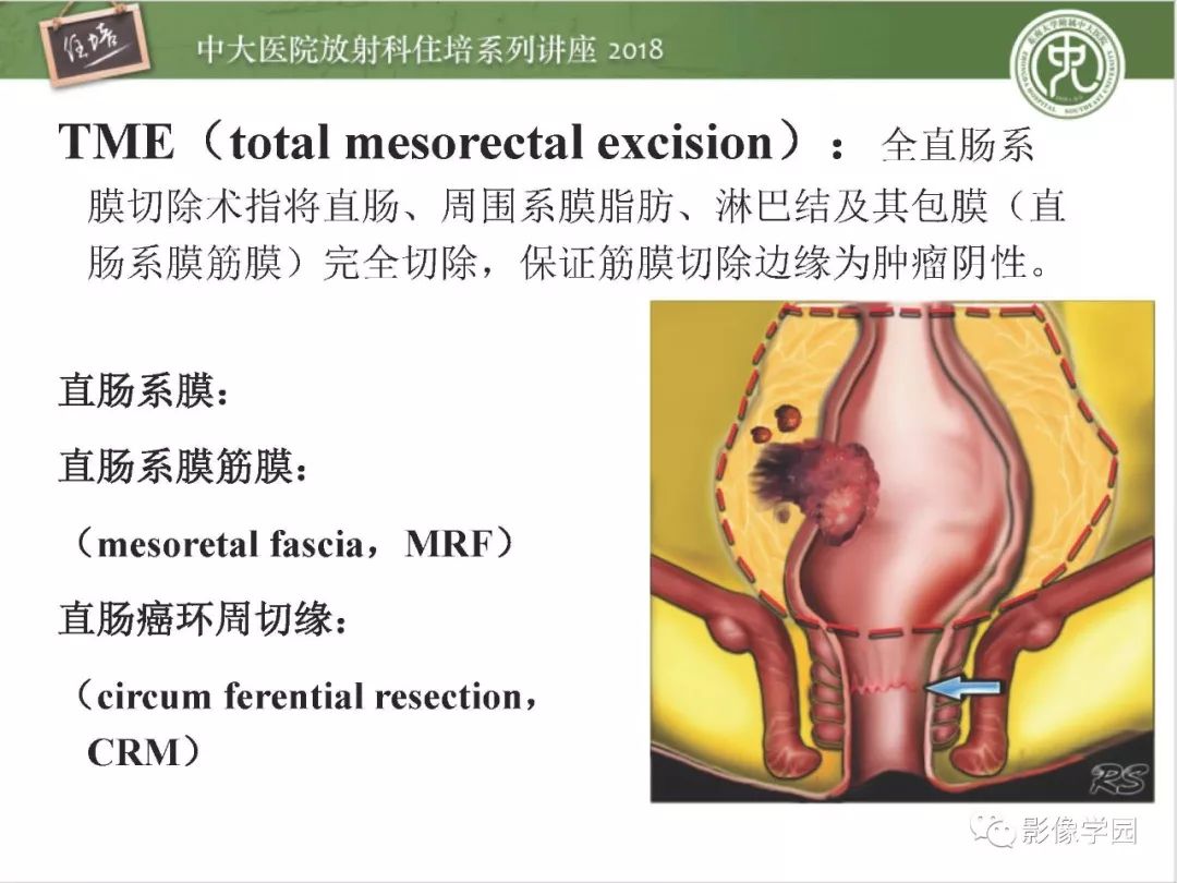 【PPT】直肠癌MR分期及报告