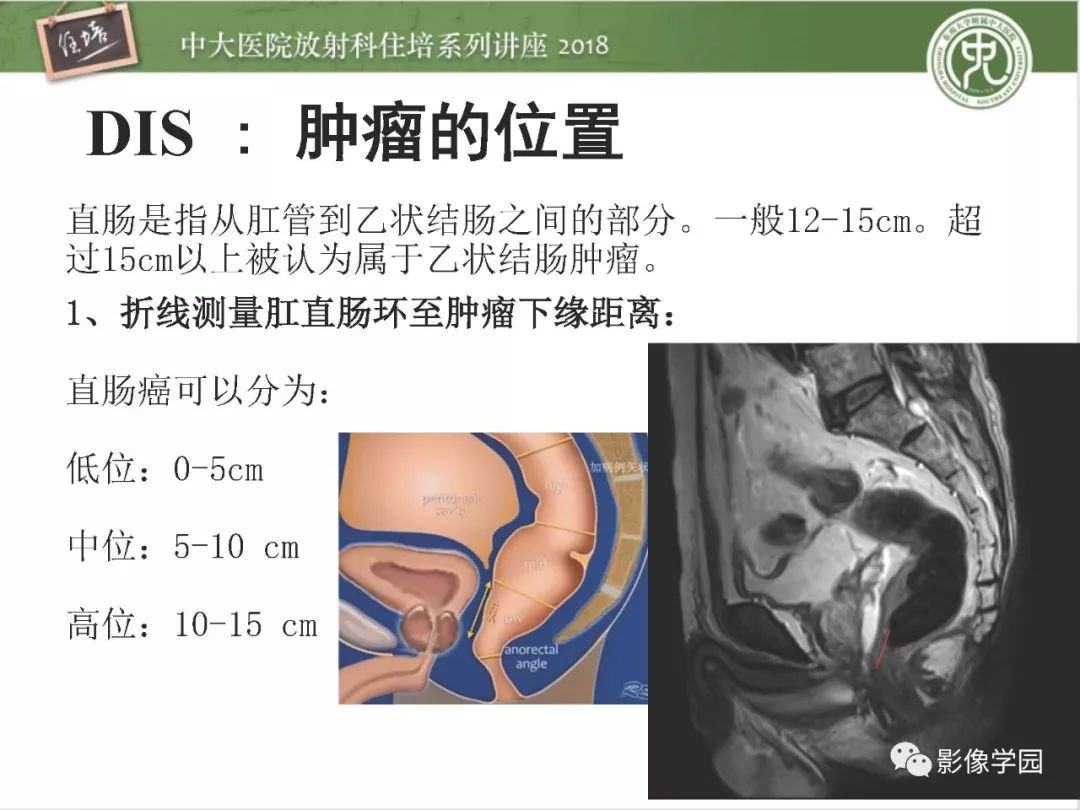 【PPT】直肠癌MR分期及报告