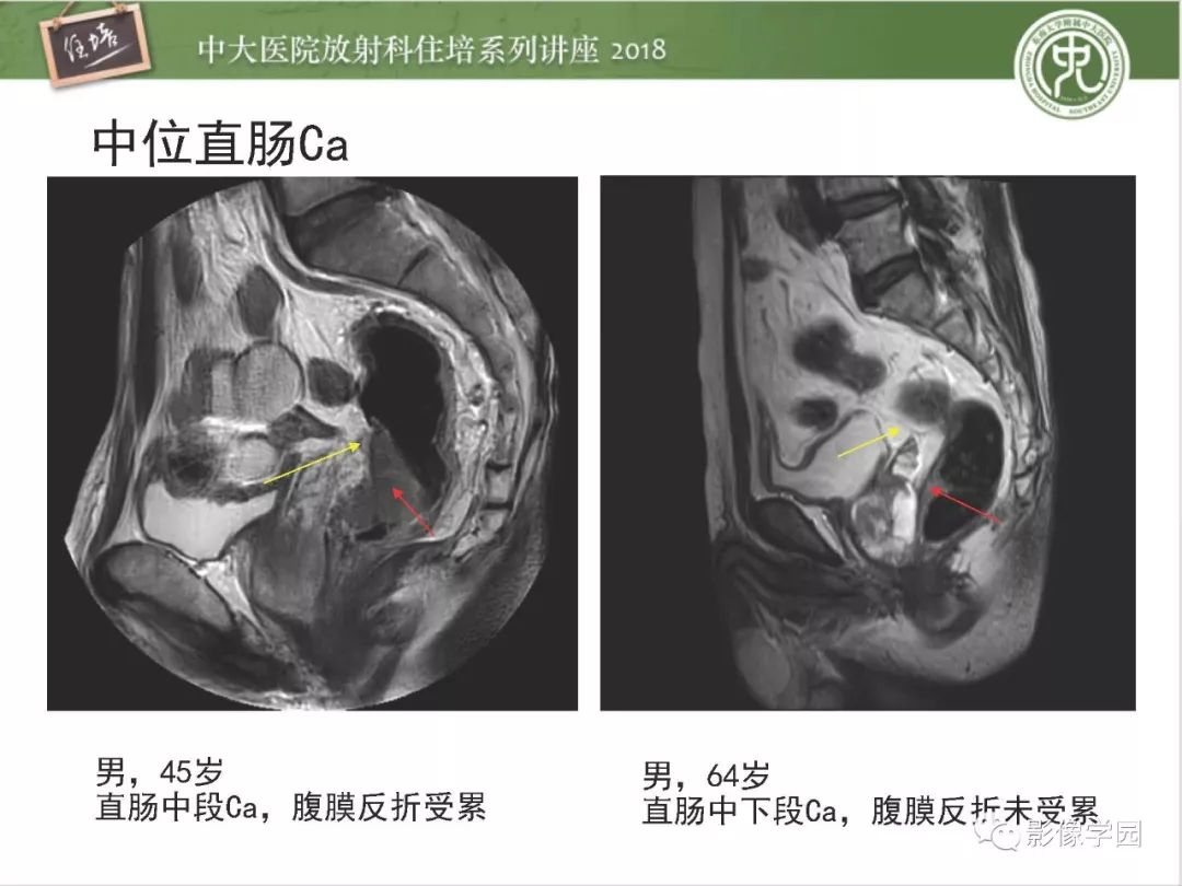 【PPT】直肠癌MR分期及报告