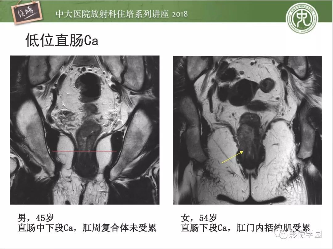 【PPT】直肠癌MR分期及报告