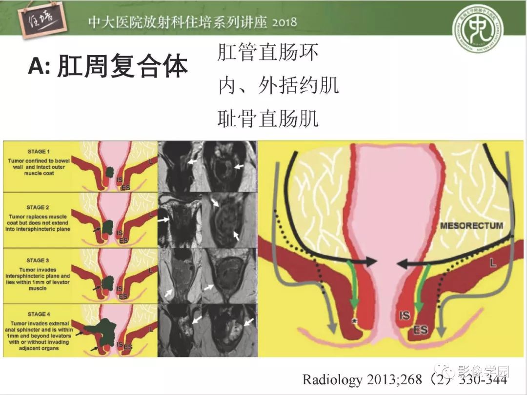 【PPT】直肠癌MR分期及报告