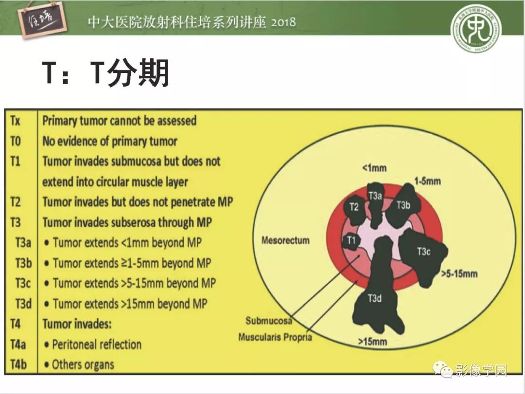 【PPT】直肠癌MR分期及报告