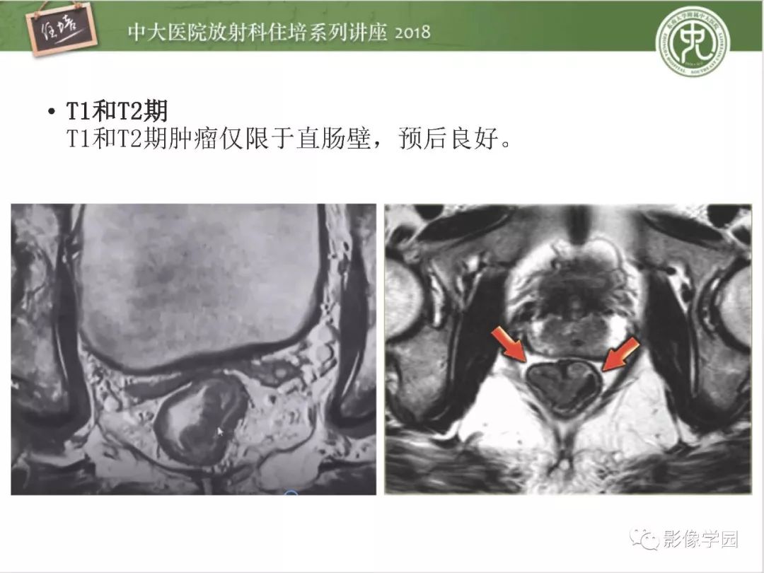 【PPT】直肠癌MR分期及报告