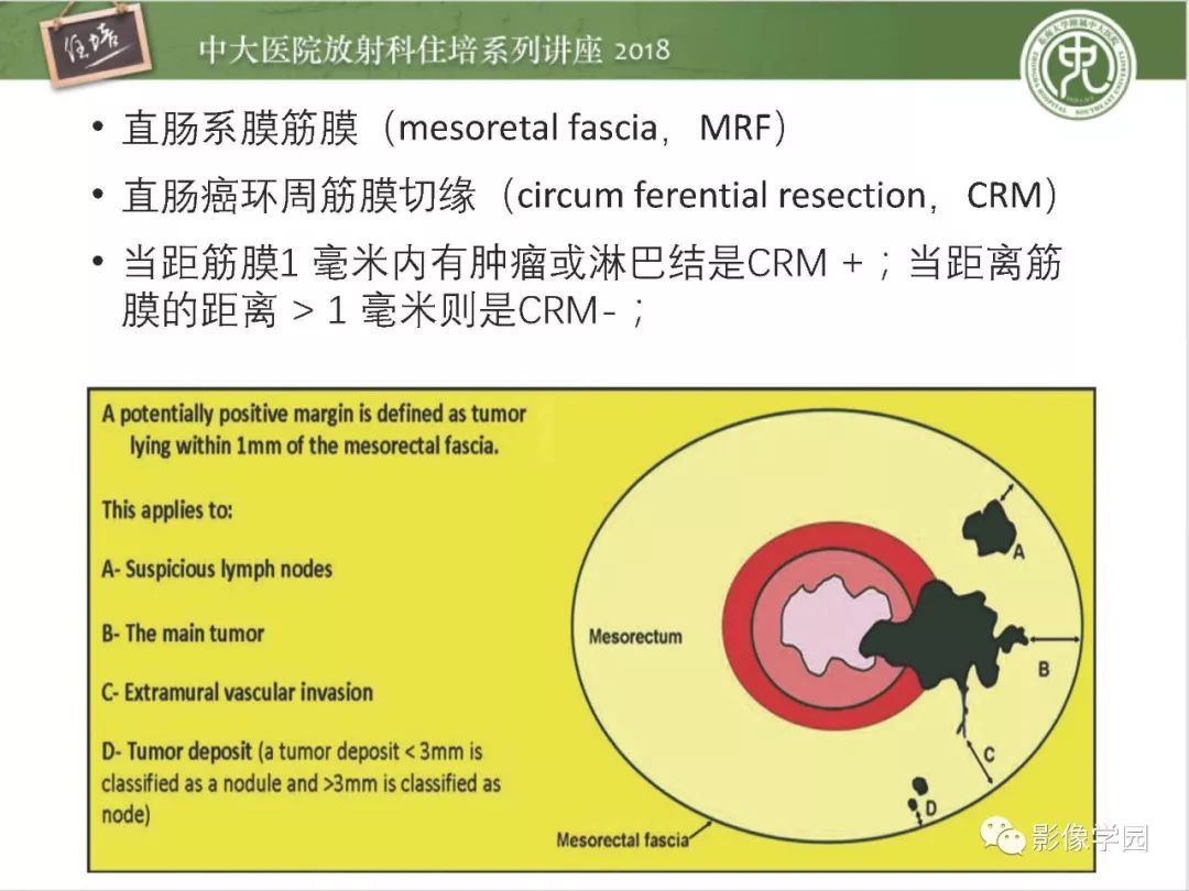 【PPT】直肠癌MR分期及报告