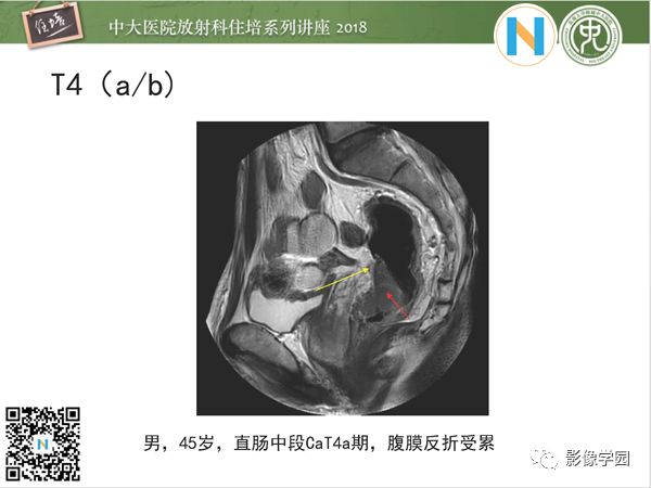 【PPT】直肠癌MR分期及报告