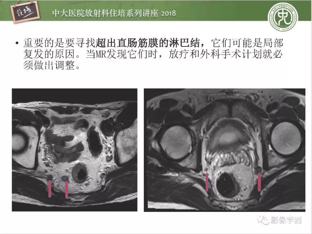 【PPT】直肠癌MR分期及报告