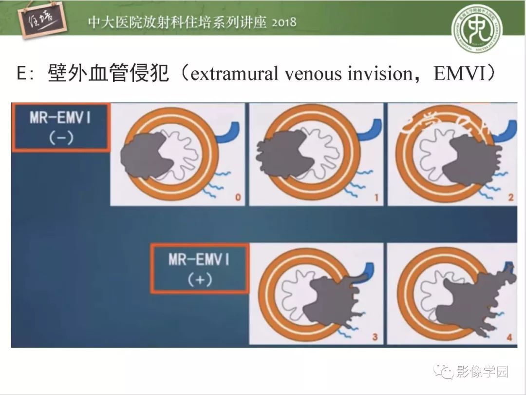 【PPT】直肠癌MR分期及报告