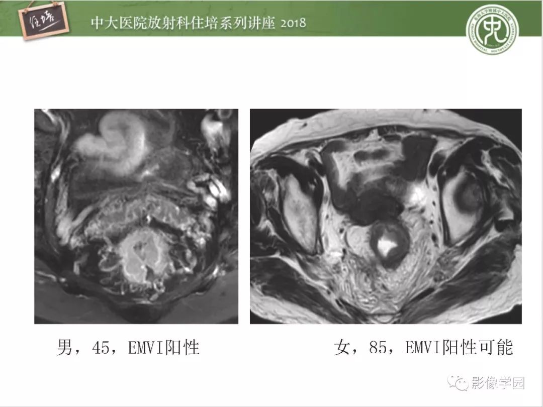 【PPT】直肠癌MR分期及报告