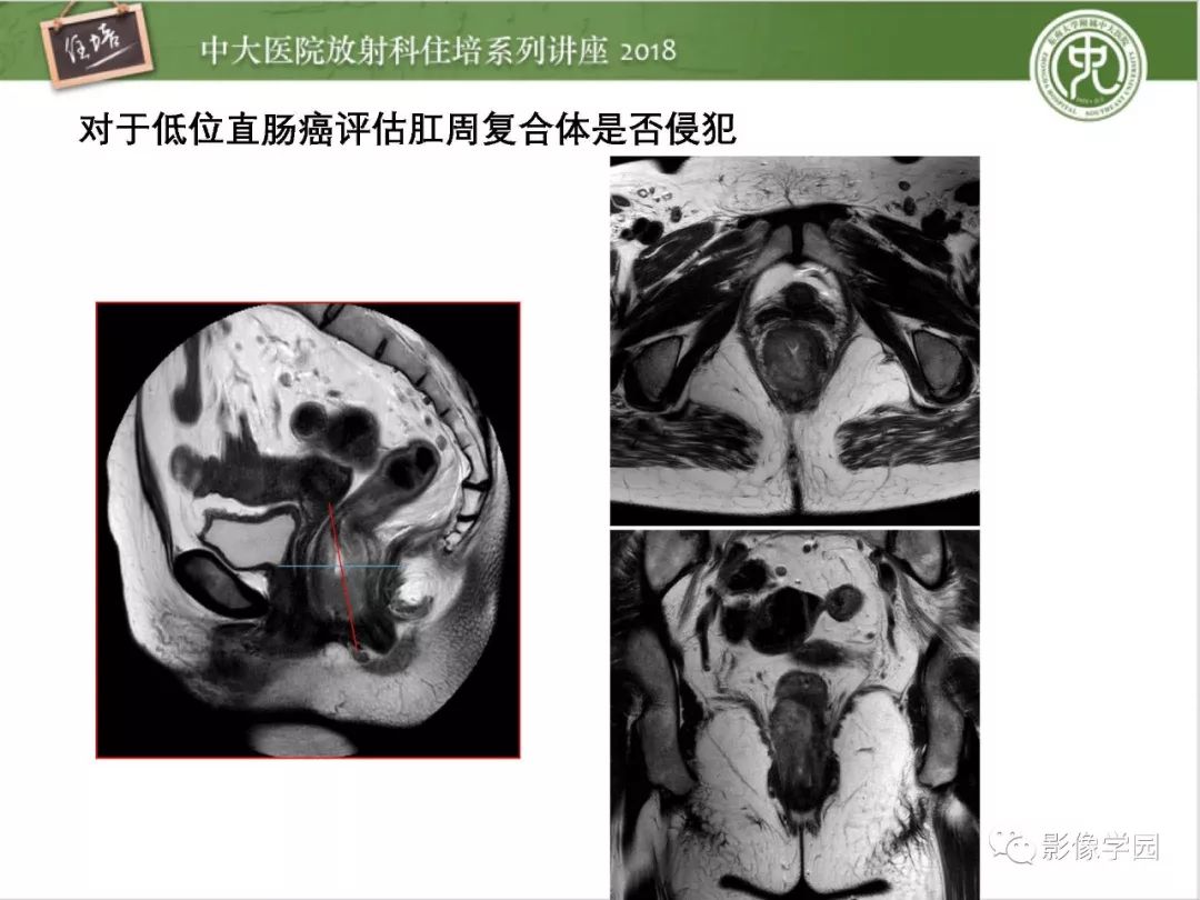 【PPT】直肠癌MR分期及报告