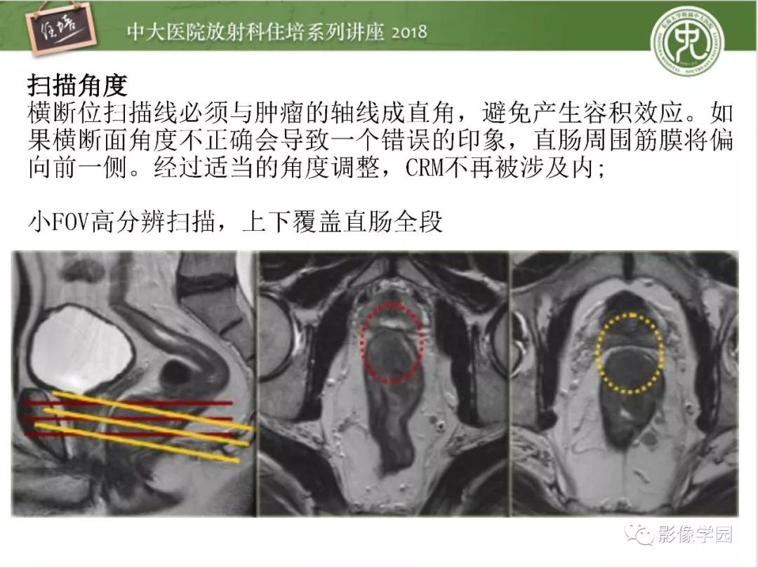 【PPT】直肠癌MR分期及报告