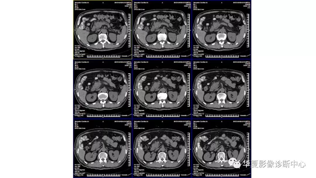 【病例】胰腺胰管内乳头状粘液性肿瘤1例CT及MR