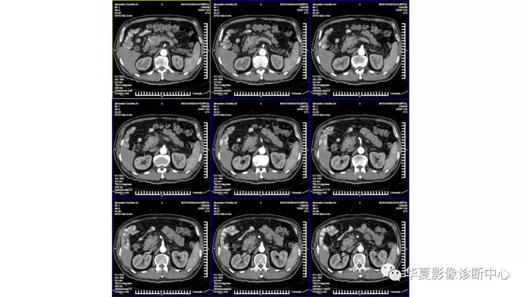 【病例】胰腺胰管内乳头状粘液性肿瘤1例CT及MR