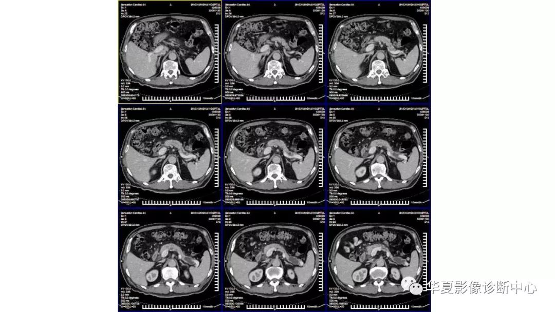 【病例】胰腺胰管内乳头状粘液性肿瘤1例CT及MR