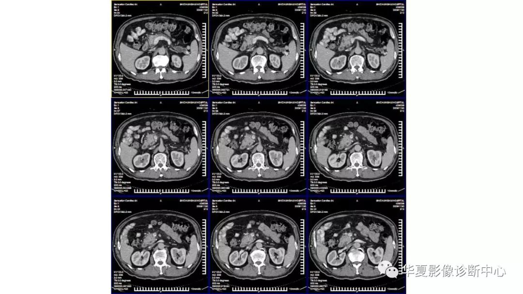 【病例】胰腺胰管内乳头状粘液性肿瘤1例CT及MR
