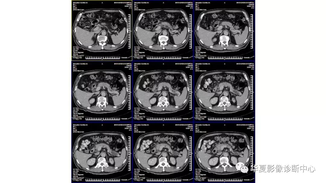 【病例】胰腺胰管内乳头状粘液性肿瘤1例CT及MR