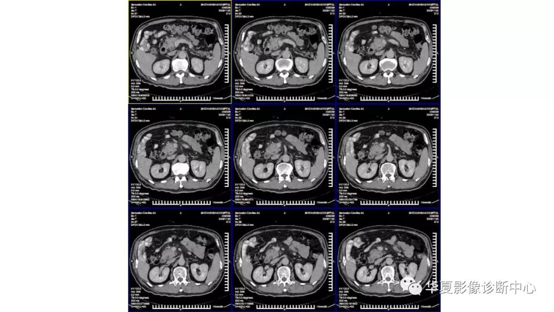 【病例】胰腺胰管内乳头状粘液性肿瘤1例CT及MR