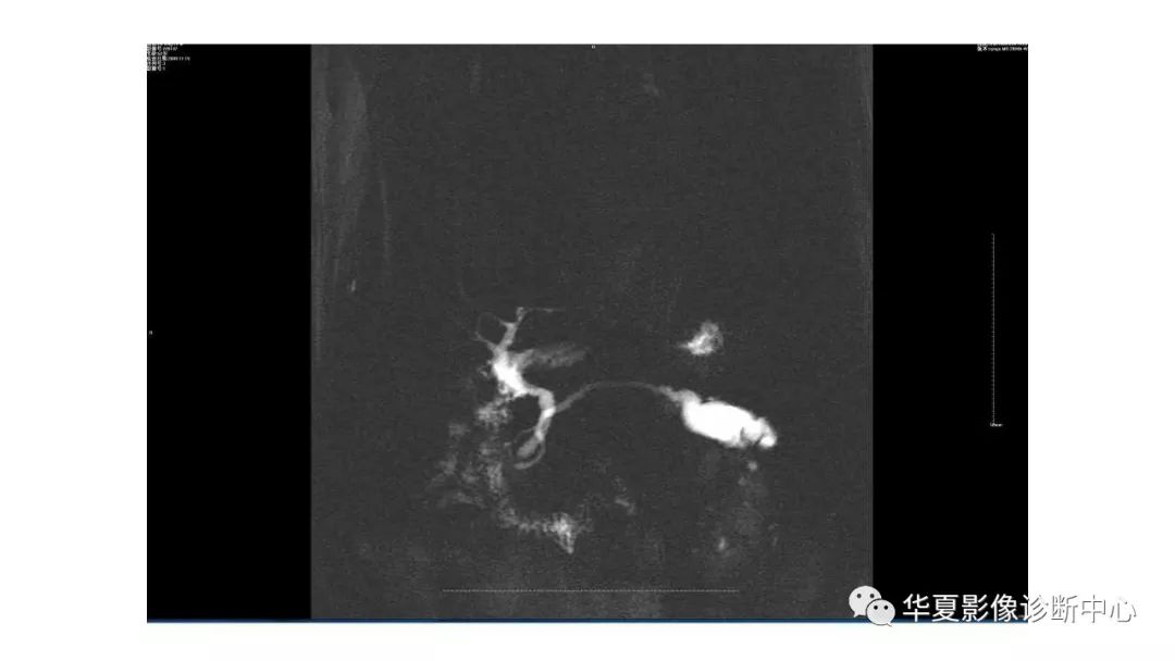 【病例】胰腺胰管内乳头状粘液性肿瘤1例CT及MR