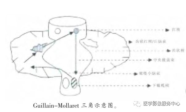 【病例】肥大性下橄榄核变性1例MR