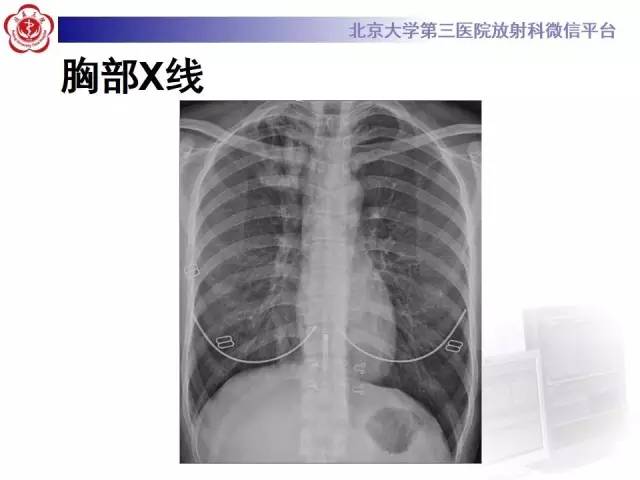 【病例】变态反应性支气管肺曲霉菌病1例CT