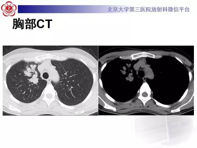 【病例】变态反应性支气管肺曲霉菌病1例CT