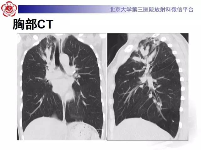 【病例】变态反应性支气管肺曲霉菌病1例CT