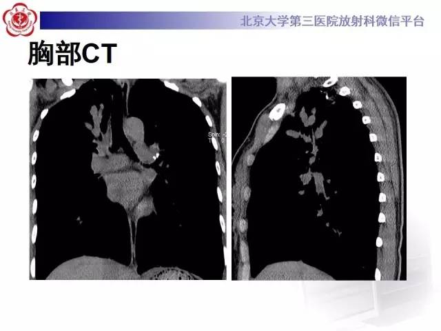 【病例】变态反应性支气管肺曲霉菌病1例CT