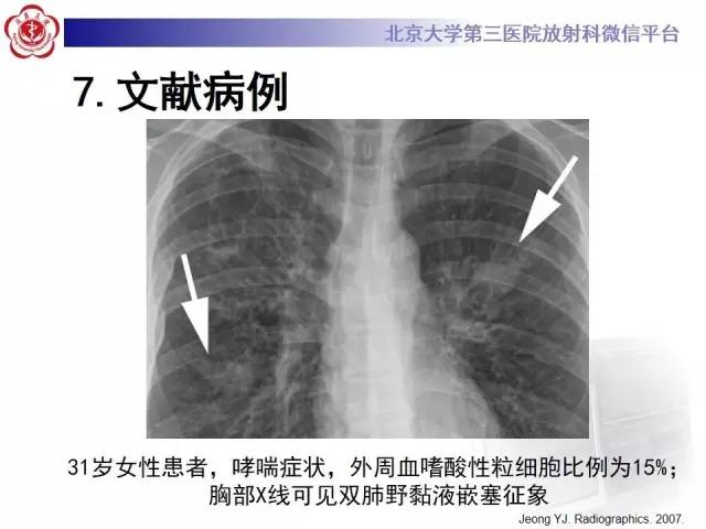 【病例】变态反应性支气管肺曲霉菌病1例CT