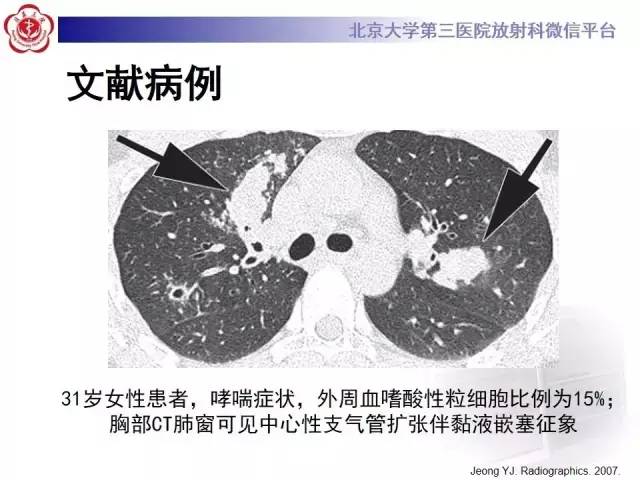 【病例】变态反应性支气管肺曲霉菌病1例CT