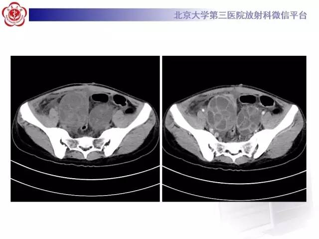 【病例】卵巢过度刺激综合征1例CT影像表现