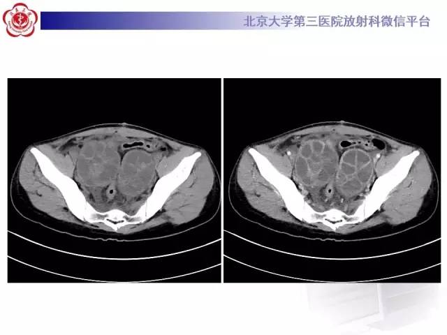 【病例】卵巢过度刺激综合征1例CT影像表现