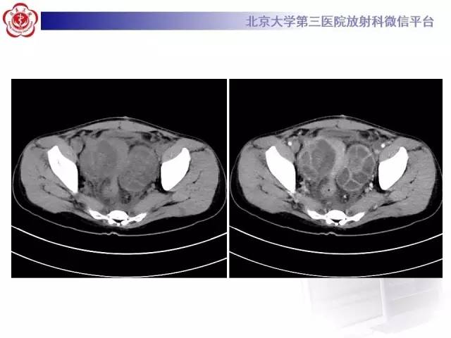 【病例】卵巢过度刺激综合征1例CT影像表现