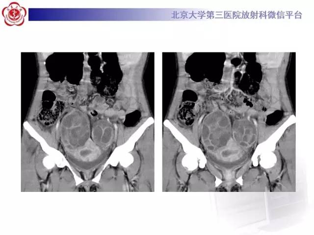 【病例】卵巢过度刺激综合征1例CT影像表现