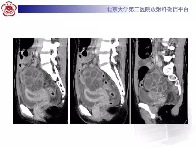 【病例】卵巢过度刺激综合征1例CT影像表现