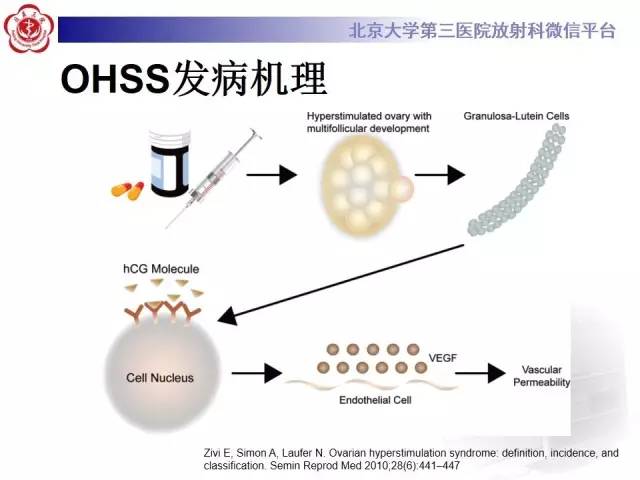 【病例】卵巢过度刺激综合征1例CT影像表现