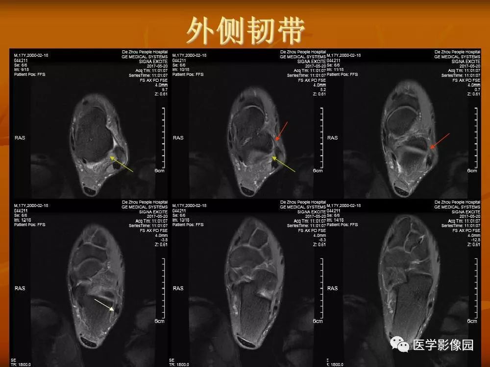 【PPT】踝关节韧带的解剖及影像表现