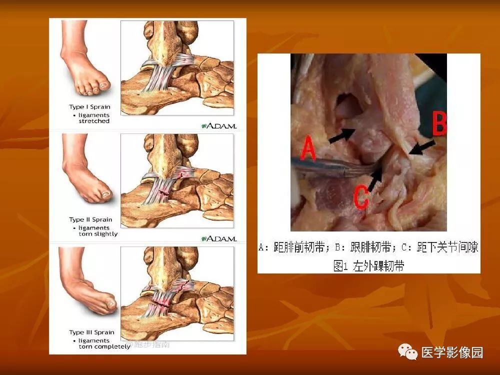 【PPT】踝关节韧带的解剖及影像表现
