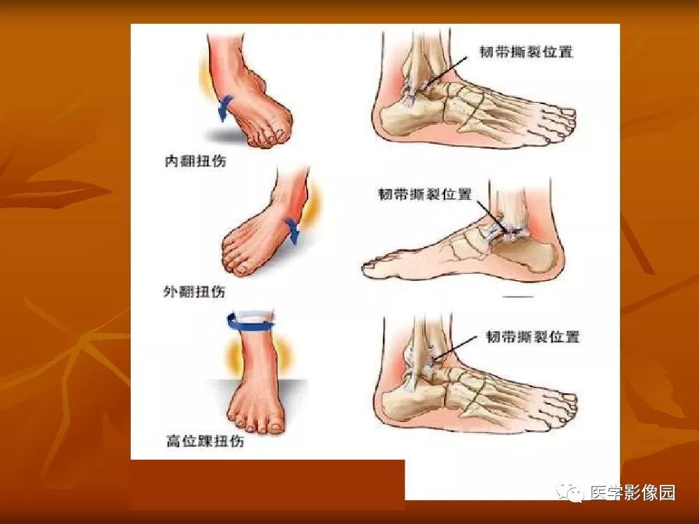 【PPT】踝关节韧带的解剖及影像表现