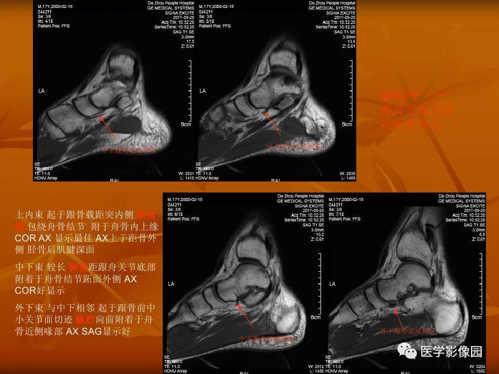 【PPT】踝关节韧带的解剖及影像表现