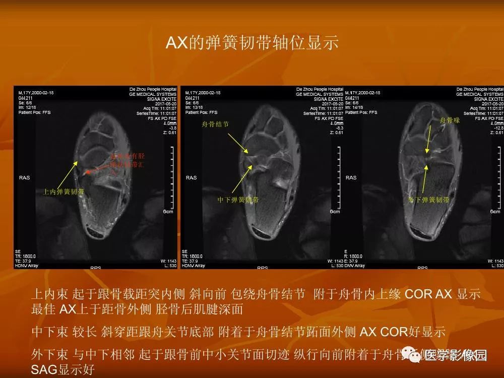【PPT】踝关节韧带的解剖及影像表现