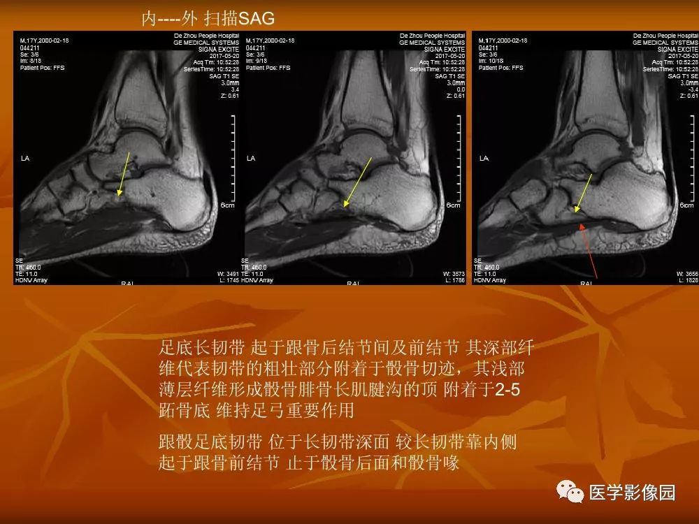 【PPT】踝关节韧带的解剖及影像表现