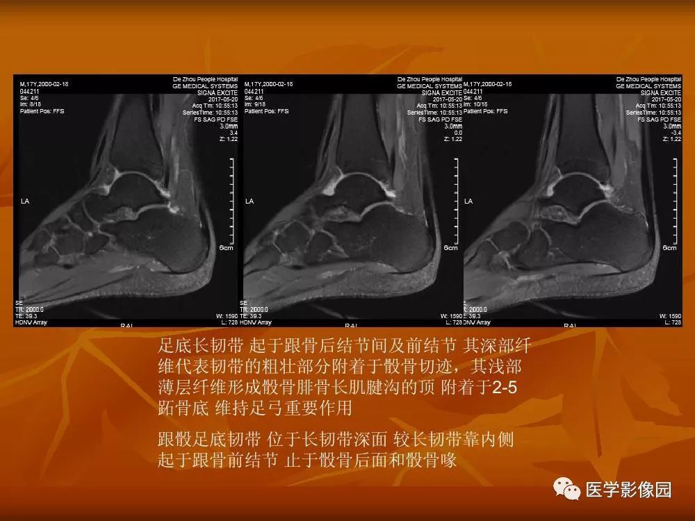 【PPT】踝关节韧带的解剖及影像表现