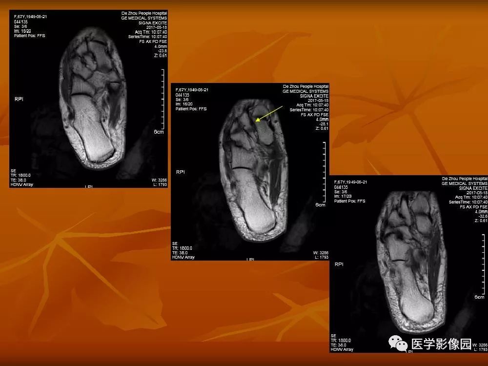 【PPT】踝关节韧带的解剖及影像表现