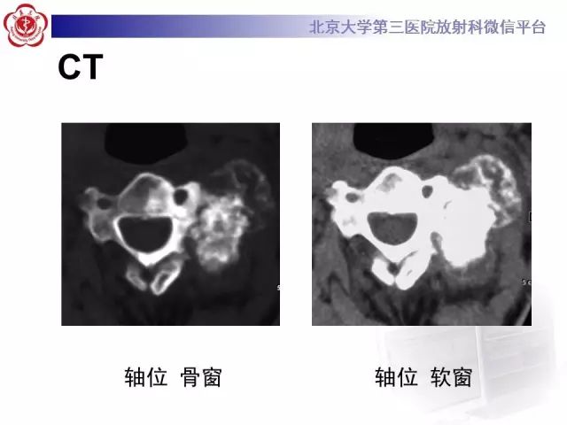 【病例】颈椎骨母细胞瘤1例CT影像表现