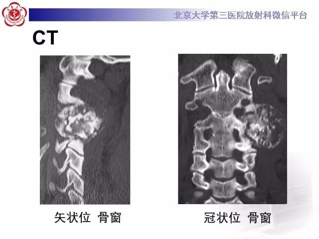 【病例】颈椎骨母细胞瘤1例CT影像表现