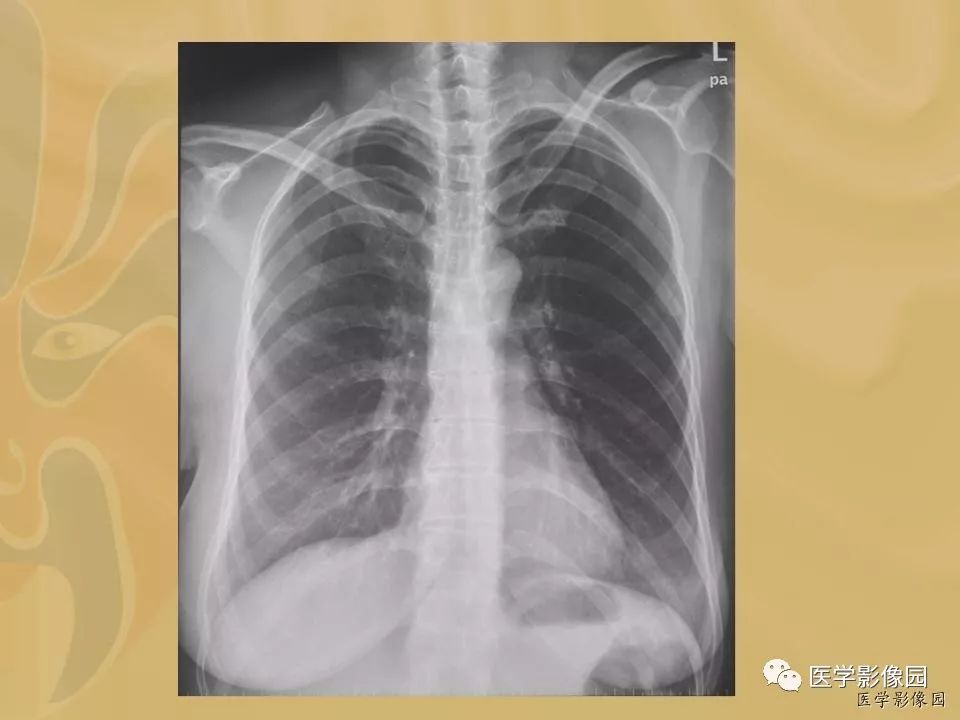 【病例】骨化性肌炎1例X线CT及MR影像表现