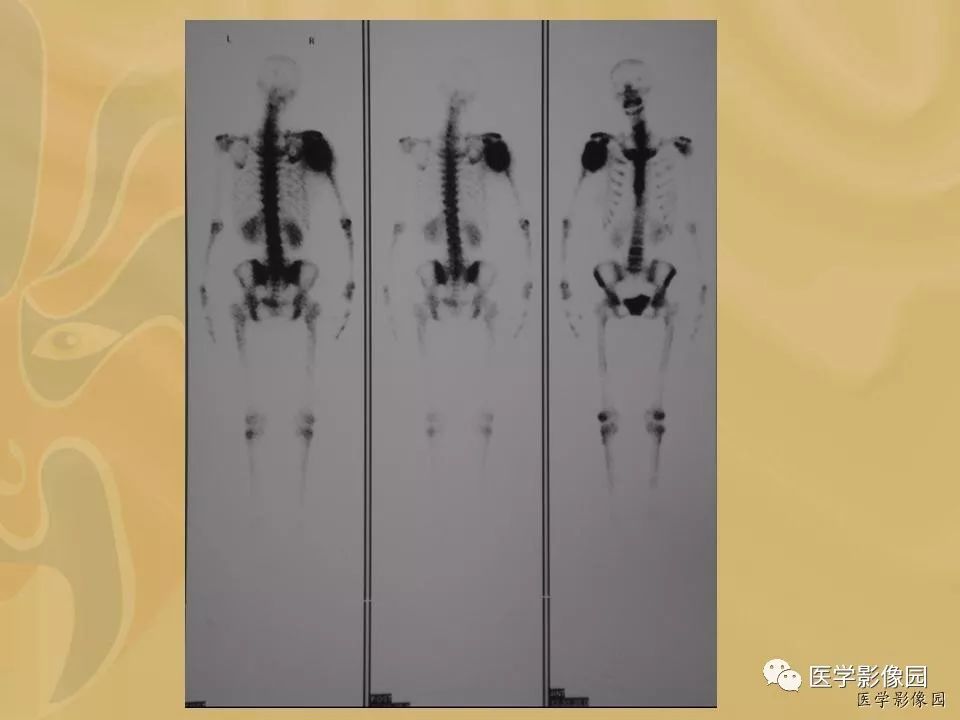 【病例】骨化性肌炎1例X线CT及MR影像表现