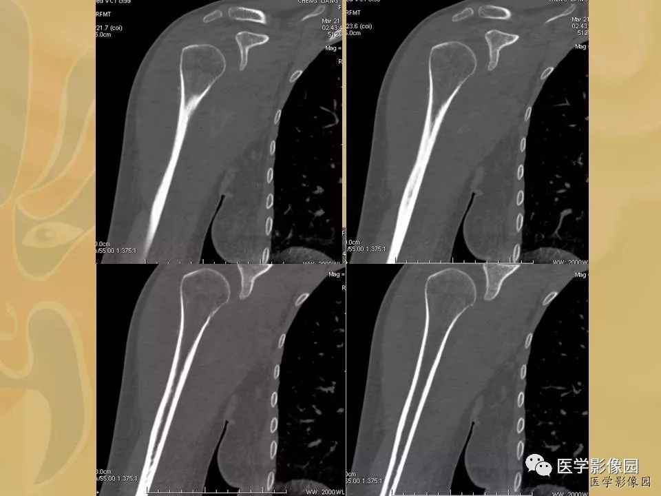 【病例】骨化性肌炎1例X线CT及MR影像表现
